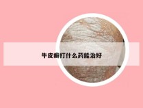 牛皮癣打什么药能治好