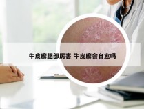 牛皮廨腿部厉害 牛皮廨会自愈吗