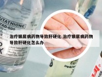 治疗银屑病药物导致肝硬化 治疗银屑病药物导致肝硬化怎么办