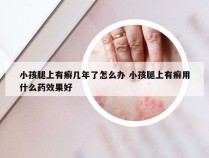 小孩腿上有癣几年了怎么办 小孩腿上有癣用什么药效果好