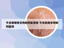 牛皮癣哪些生物制剂能报销 牛皮肤癣生物制剂医保