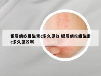 银屑病吃维生素c多久见效 银屑病吃维生素c多久见效啊