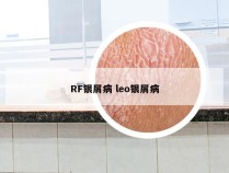 RF银屑病 leo银屑病