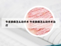 牛皮肤癣怎么动手术 牛皮肤癣怎么动手术治疗