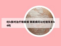 吃b族对治疗银屑病 银屑病可以吃维生素b4吗