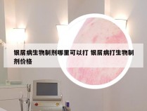 银屑病生物制剂哪里可以打 银屑病打生物制剂价格