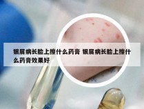 银屑病长脸上擦什么药膏 银屑病长脸上擦什么药膏效果好