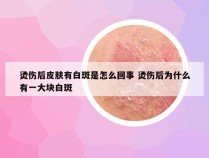 烫伤后皮肤有白斑是怎么回事 烫伤后为什么有一大块白斑