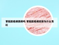 掌跖脓疱病很痒吗 掌跖脓疱病皮肤为什么发红