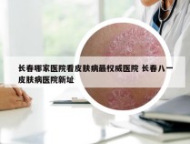 长春哪家医院看皮肤病最权威医院 长春八一皮肤病医院新址