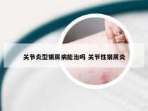 关节炎型银屑病能治吗 关节性银屑炎