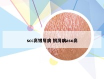 scc高银屑病 银屑病aso高