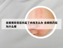 皮癣用软膏后长起了肉堆怎么办 皮癣擦药后为什么痒