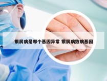 银屑病是哪个基因异常 银屑病致病基因