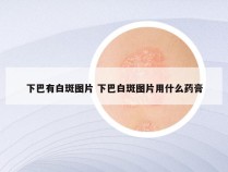 下巴有白斑图片 下巴白斑图片用什么药膏