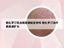 他扎罗汀乳治银屑病蜕皮快吗 他扎罗汀治疗银屑病扩大