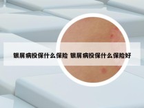 银屑病投保什么保险 银屑病投保什么保险好