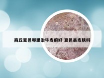 商丘夏邑哪里治牛皮癣好 夏邑县皮肤科