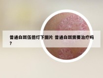 普通白斑伍德灯下图片 普通白斑需要治疗吗?