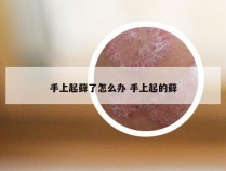 手上起藓了怎么办 手上起的藓