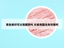 黑色癣印可以用醋擦吗 长癣用醋洗有效果吗