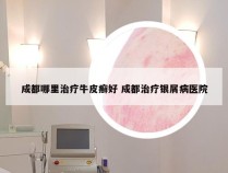 成都哪里治疗牛皮癣好 成都治疗银屑病医院