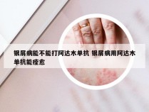 银屑病能不能打阿达木单抗 银屑病用阿达木单抗能痊愈