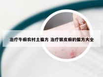 治疗牛癣农村土偏方 治疗银皮癣的偏方大全