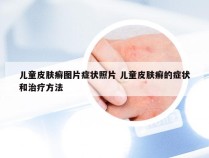 儿童皮肤癣图片症状照片 儿童皮肤癣的症状和治疗方法