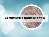 长春皮肤病医院排名 长春皮肤病医院排名第一