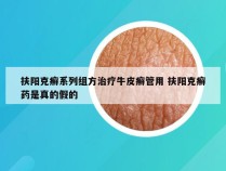 扶阳克癣系列组方治疗牛皮癣管用 扶阳克癣药是真的假的