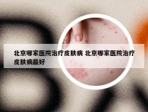 北京哪家医院治疗皮肤病 北京哪家医院治疗皮肤病最好