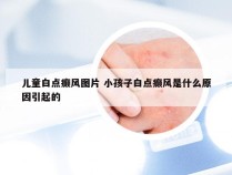 儿童白点癫风图片 小孩子白点癫风是什么原因引起的