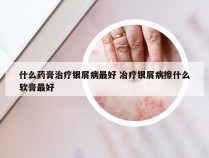 什么药膏治疗银屑病最好 冶疗银屑病擦什么软膏最好