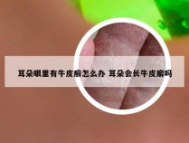 耳朵眼里有牛皮癣怎么办 耳朵会长牛皮廨吗