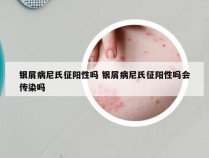 银屑病尼氏征阳性吗 银屑病尼氏征阳性吗会传染吗