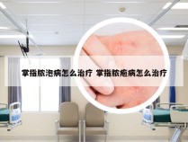 掌指脓泡病怎么治疗 掌指脓疱病怎么治疗