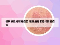 银屑病能打新冠疫苗 银屑病患者能打新冠疫苗