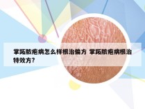 掌跖脓疱病怎么样根治偏方 掌跖脓疱病根治特效方?