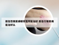 脓包性银屑病哪家医院能治好 脓包行银屑病能治好么