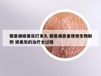 银屑病修美乐打多久 银屑病患者使用生物制剂 修美乐的治疗全过程