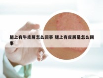 腿上有牛皮屑怎么回事 腿上有皮屑是怎么回事