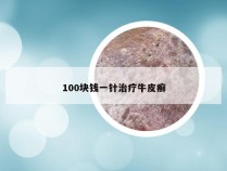 100块钱一针治疗牛皮癣