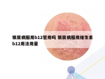 银屑病服用b12管用吗 银屑病服用维生素b12用法用量