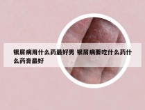 银屑病用什么药最好男 银屑病要吃什么药什么药膏最好