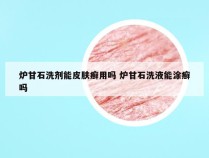 炉甘石洗剂能皮肤癣用吗 炉甘石洗液能涂癣吗