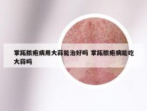 掌跖脓疱病用大蒜能治好吗 掌跖脓疱病能吃大蒜吗