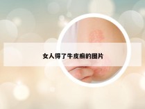 女人得了牛皮癣的图片