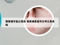 银屑病不能公务员 银屑病患者可以考公务员吗