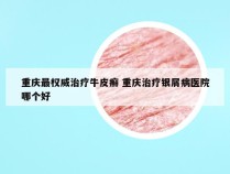 重庆最权威治疗牛皮癣 重庆治疗银屑病医院哪个好